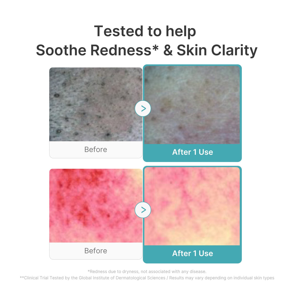 Azelaic Acid Capsule Foam Cleanser V0