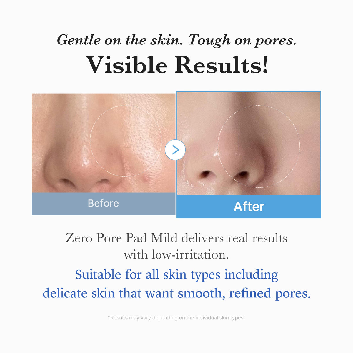 Zero Pore Madecassoside Pads (Mild) N3